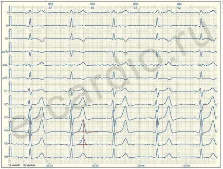 E-cardio semne de ischemie