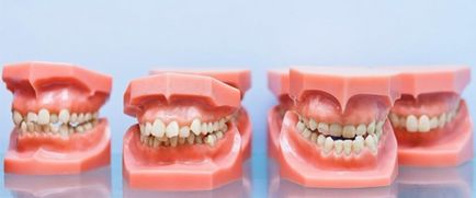 Eroziunea eroziunii dinților dinților de dinți