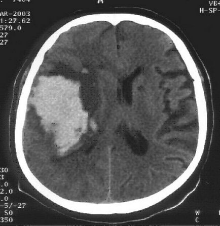 Hemangiomul creierului la adulți și copiilor (congenital), simptome și tratament (îndepărtare)