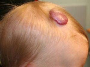 Hemangioma csecsemők fején