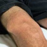 Hygroma fotografiei genunchiului și a tratamentului genunchiului