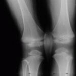 Гігрома колінного суглоба лікування та діагностика