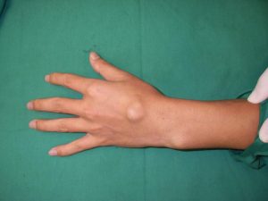Hernia la încheietura mâinii cu higromă, tratament