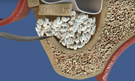 Implantarea dinților și efectele fumatului după implantare