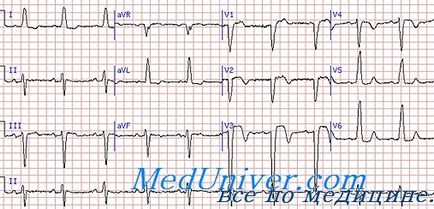 Infarctul miocardic al tratamentului atrial - inimă