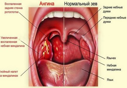 Perioada de incubație a anginei la copii și adulți