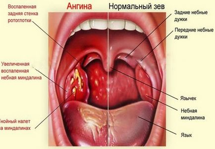 Інкубаційний період ангіни у дітей і дорослих