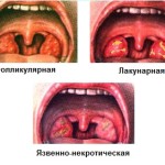 Інкубаційний період ангіни у дорослих і дітей 1