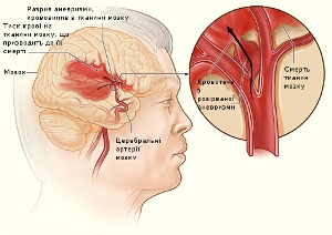 Accident vascular cerebral consecinte - tratament cardiac