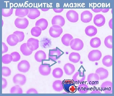Дослідження тромбоцитів в мазку крові
