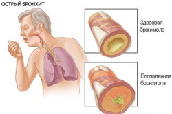 Cum bronșita trece în pneumonie