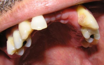 Як правильно поєднати лікування брекетами і зубними імплантатами