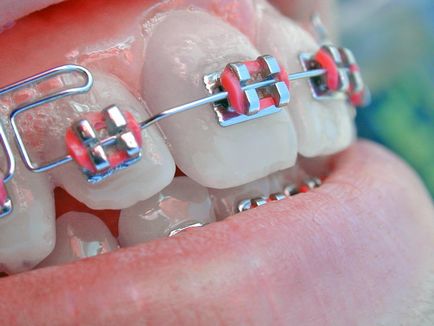 Як правильно поєднати лікування брекетами і зубними імплантатами
