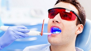 Як ставиться фотополімерна пломба в стоматології