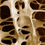 Як захистити свої кістки від остеопорозу, лікування в Німеччині, медицина в європі