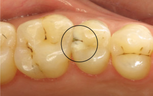 Карієс в стадії плями і пігментація зубів рання діагностика на початковому етапі