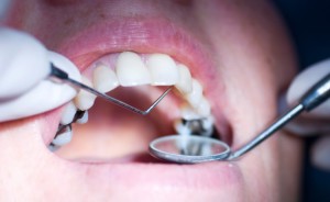 Cariile la diagnosticarea timpurie a diagnosticului precoce la punctul și pigmentul dintelui la etapa inițială