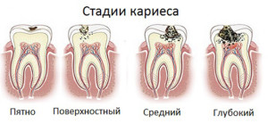 Üregek a folt fogak pigmentáció a lépést, és a korai diagnózis a kezdeti fázisban