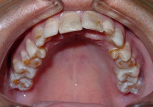 Üregek a folt fogak pigmentáció a lépést, és a korai diagnózis a kezdeti fázisban