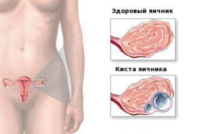 Chist ovarian - simptome, diagnostic și tratament al chisturilor