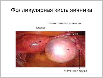 Chist ovarian - simptome, diagnostic și tratament al chisturilor