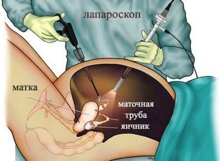 Кіста яєчника - симптоми, діагностика та лікування кіст