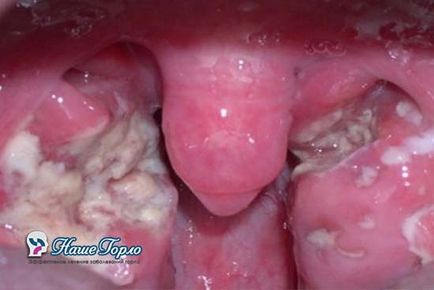 Lacunar angina simptome, tratament la adulți, fotografie (fotografie) Lacune angina simptome, tratament la adulți, fotografie
