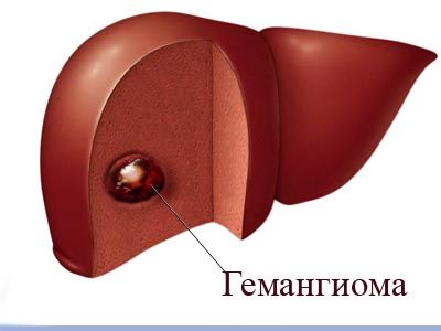 Лікування гемангіоми печінки народними засобами