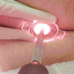 Лікування геморою за допомогою лазерної технології