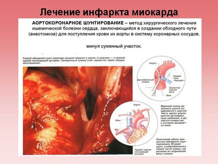 Лікування інфаркту міокарда - презентація 5130-15