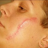 Tratamentul cicatricelor post-acnee - bisturiu - informații medicale și portal educațional