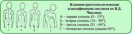 Лікування сколіозу в бельгії, консервативні і хірургічні методи лікування сколіозу за кордоном