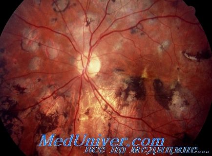 Tratamentul toxoplasmozei oculare