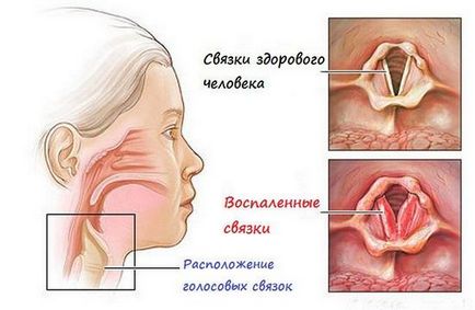 Tratamentul laringitei cronice, cauzele, tipurile și simptomele acesteia