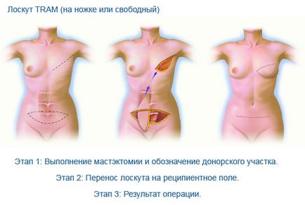 Flanșă tramvai - reconstrucție de sân cu o clapă de tramvai