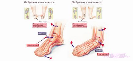 Масаж при плосковальгусной стопі у дітей техніка масажу ніг при вальгусной деформації