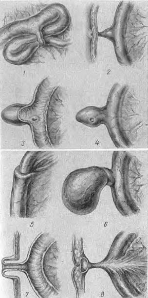 Meckel tratamentul diverticulului simptomelor