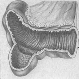 Meckel tratamentul diverticulului simptomelor