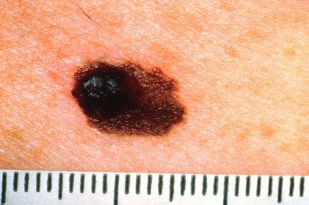 Melanoma a gyermekek jelei, tünetei és kezelése