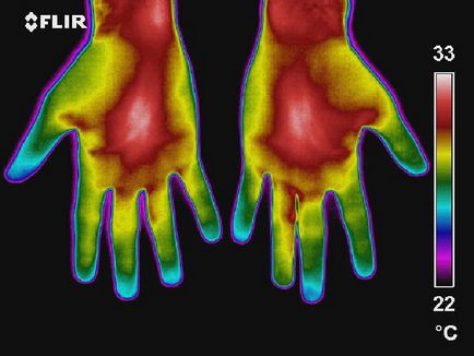 Melanoma tünetek gyermekeknél, mint amilyennek látszik, a kezelés, videó, fotó példák