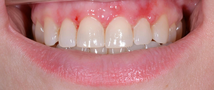Módszerek megszüntetésére fogíny mosoly - Department of Dentistry atribeaute Clinique (fogíny) Módszerek megszüntetésére fogíny mosoly - Department of Dentistry atribeaute clinique
