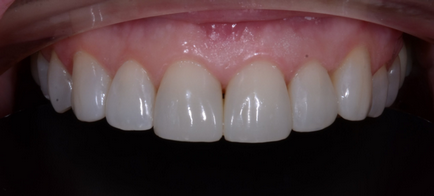 Metode de eliminare a zâmbetului gingival - Departamentul de Stomatologie atribeaute clinique