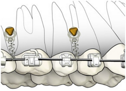 Metode de eliminare a zâmbetului gingival - Departamentul de Stomatologie atribeaute clinique