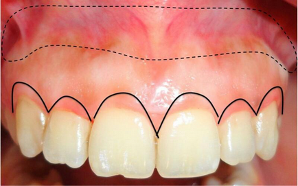 Metode de eliminare a zâmbetului gingival - Departamentul de Stomatologie atribeaute clinique