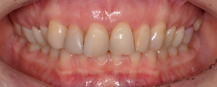 Методи усунення десневой посмішки - відділення стоматології atribeaute clinique