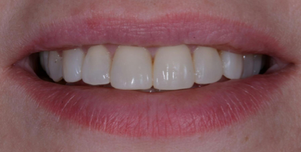 Módszerek megszüntetésére fogíny mosoly - Department of Dentistry atribeaute Clinique (mosolyog) Módszerek megszüntetésére fogíny mosoly - Department of Dentistry atribeaute clinique