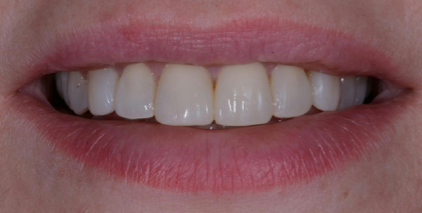 Metode de eliminare a zâmbetului gingival - Departamentul de Stomatologie atribeaute clinique