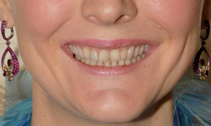 Módszerek megszüntetésére fogíny mosoly - Department of Dentistry atribeaute Clinique (mosolyog) Módszerek megszüntetésére fogíny mosoly - Department of Dentistry atribeaute clinique