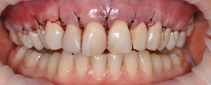 Методи усунення десневой посмішки - відділення стоматології atribeaute clinique