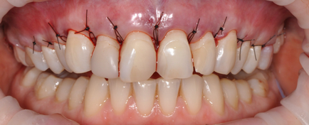 Módszerek megszüntetésére fogíny mosollyal - ága fogászat atribeaute Clinique (gingiva mosoly eliminációs módszerek fogászat módszerek) Módszerek megszüntetésére fogíny mosoly - Department of Dentistry atribeaute clinique